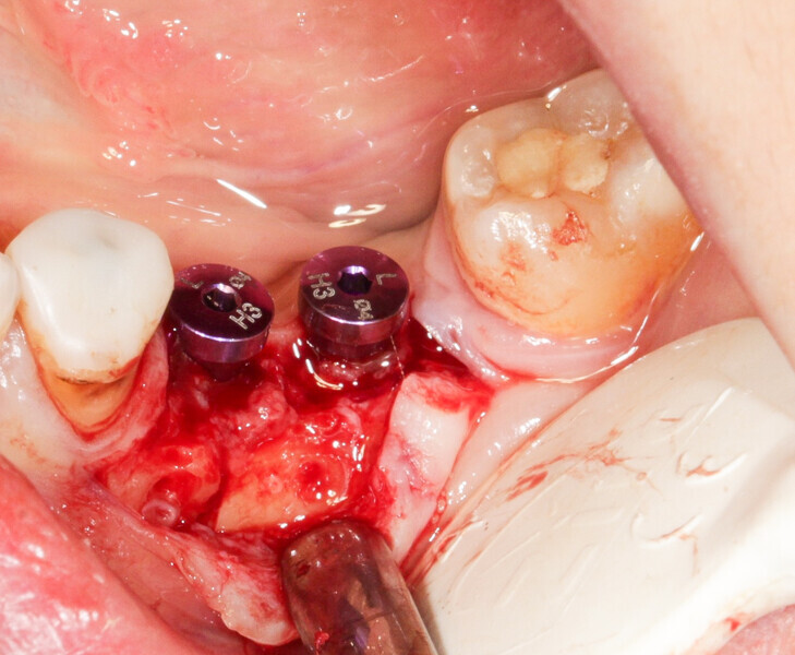 Fig. 9: The osteosynthesis screws were removed.