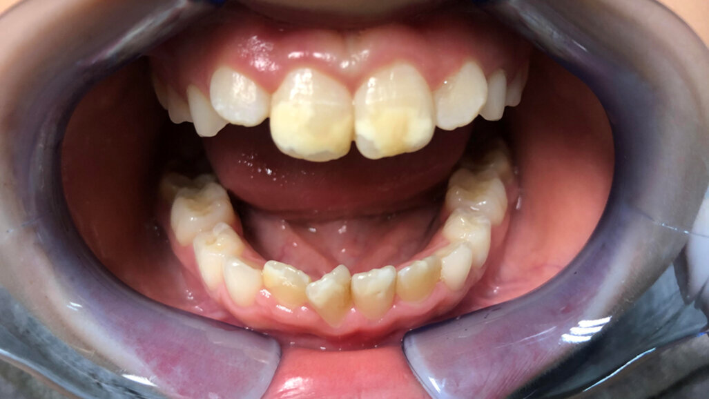 Curasept Biosmalto în stomatologia pediatrică: o abordare clinică a MIH și a îngrijirii ortodontice