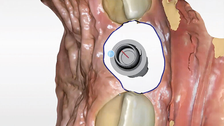 Management měkkých periimplantátových tkání pomocí kolagenní matrix a digitálního postupu