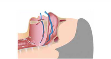 Spánková apnoe a ortodoncie: interdisciplinární přístup k léčbě chronické spánkové poruchy