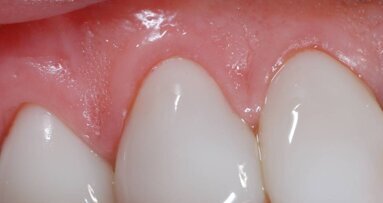 Licówki porcelanowe GlamSmile na zęby dolne i górne  Technika zakładania licówek – Część 2