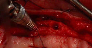 Wykorzystanie techniki poszerzania i kondensacji kości