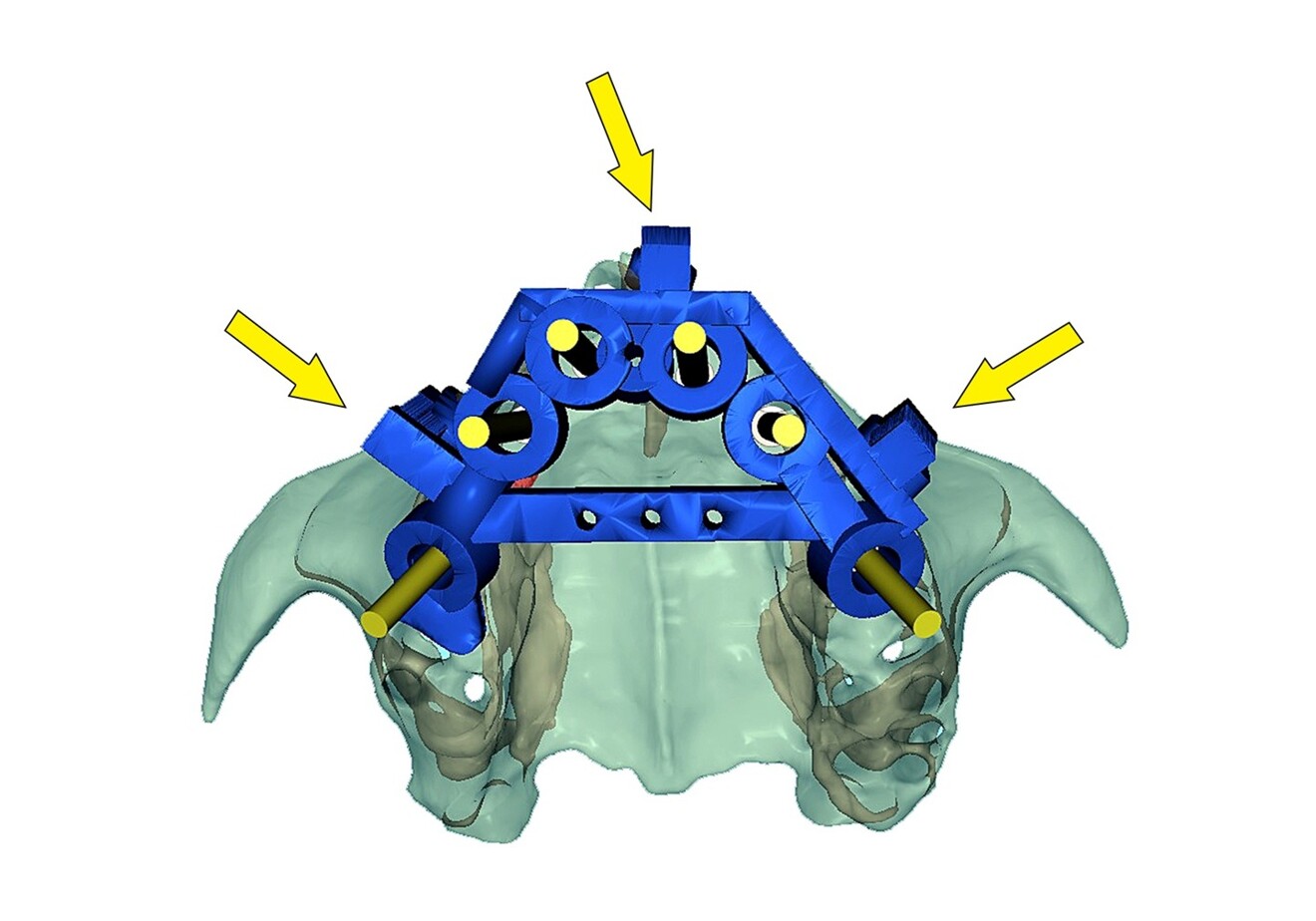 Fig. 7b: Simulation of the novel rotational path nasopalatine canal pin guide (blue) seated on the maxillary bone. Occlusal view illustrating the three buccal supports with rest seats (yellow arrows).