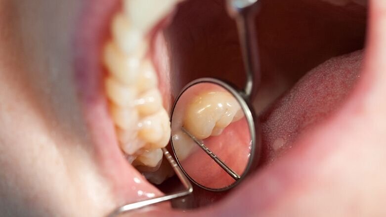 Commentaar gevraagd op conceptrichtlijn Derde molaar