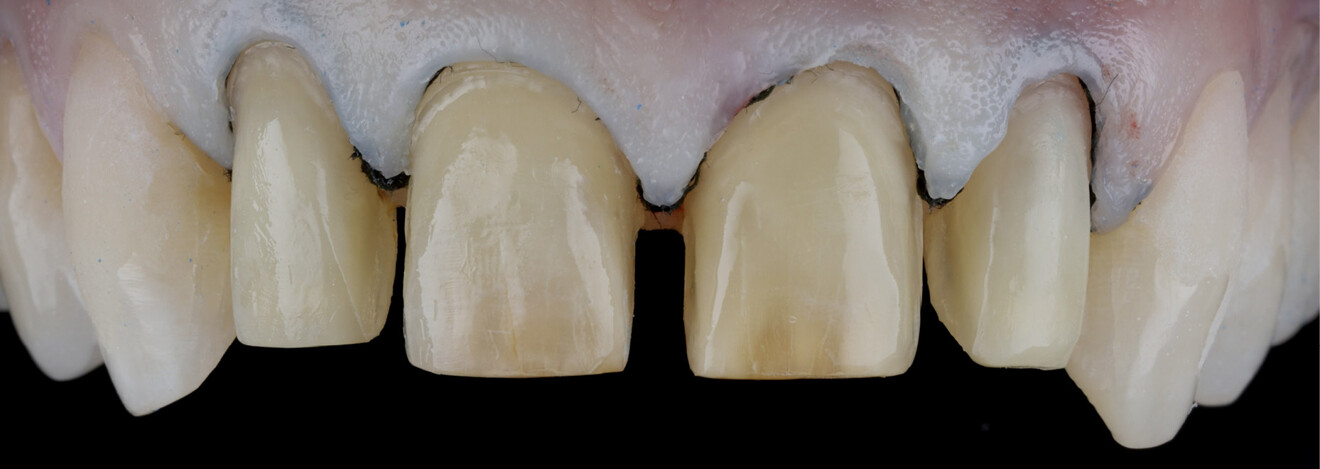Fig. 5: Clinical situation after preparation of the maxillary incisors. 