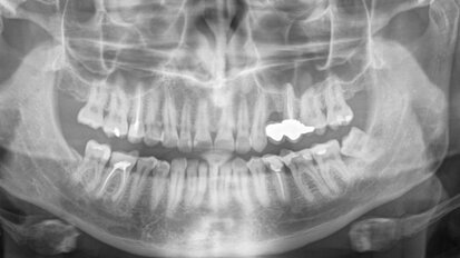 Endodontic treatment of maxillary left first molar with complicated root canal system Endodontic treatment of maxillary left first molar with complicated root canal system