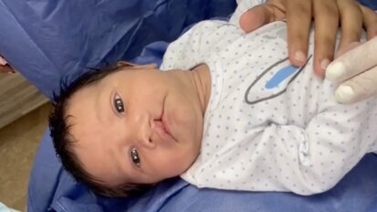 Labio y paladar fisurado Luna Video2