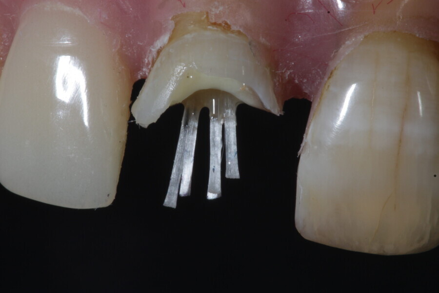 Fig. 9: Multiple fibre-reinforced flexible micro-posts are inserted.