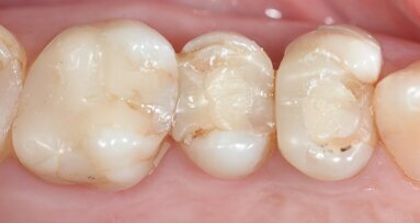 Applicazione di due corone adiacenti con un risultato altamente estetico utilizzando un flusso di lavoro digitale