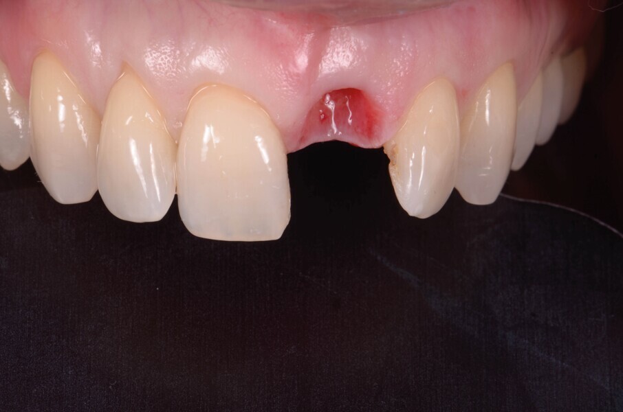 Fig. 9 c: Après une période de cicatrisation de quatre mois.