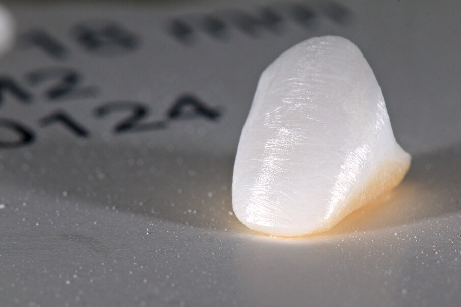 Fig. 4: The crown framework, prepared for veneering.