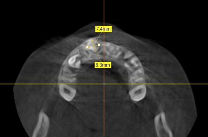 Fig. 3_Esame CBCT: proiezione assiale che evidenzia localizzazione e dimensioni della neoformazione.