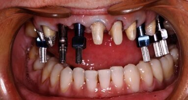 Rozwiązanie estetyczne przy wykorzystaniu pojedynczych koron na wszczepach i własnych zębach