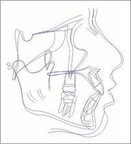 Cephalometric superimposition (using Sella- Nasion registered at Sella)