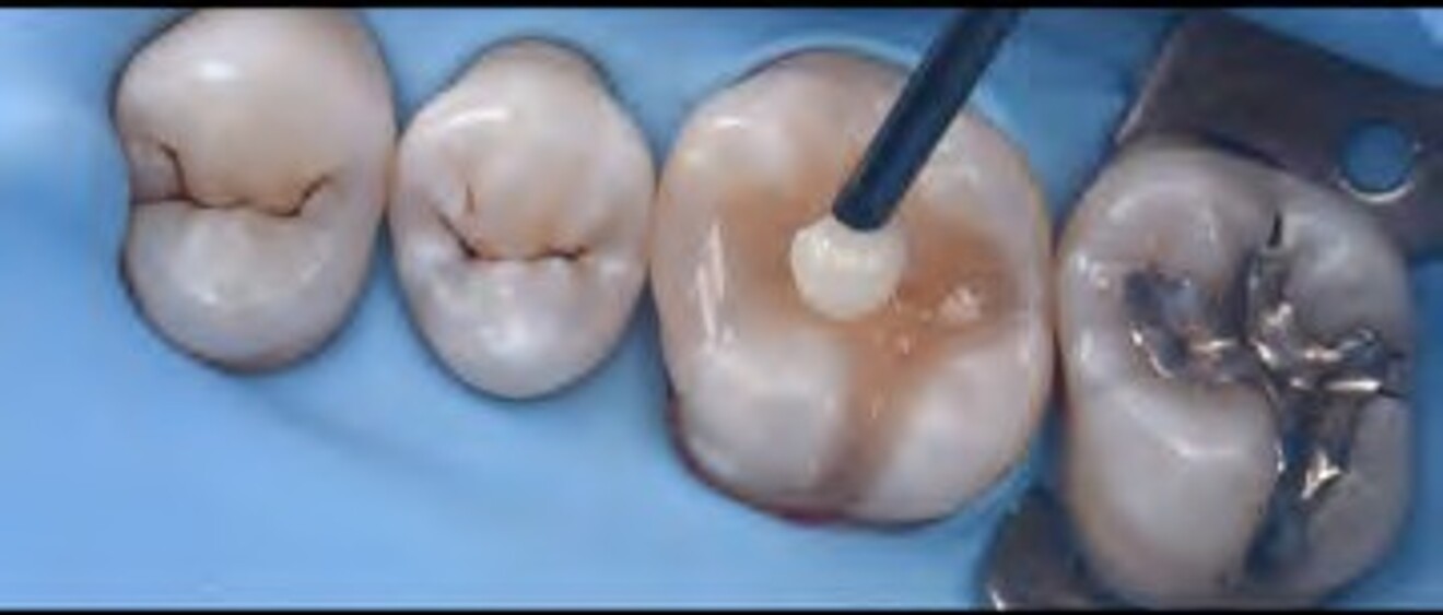  Fig. 2g: Fine adjustment of pits, fissures, and occlusal grooves to enhance anatomical  morphology. 