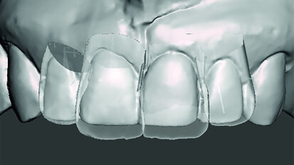 Aesthetic Digital Smile Design: 2-D-/3-D-assisted communication and software design