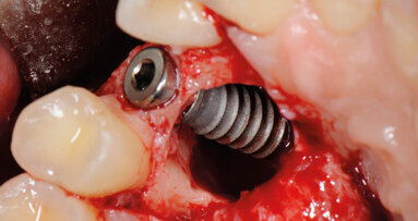 Inclusione canina e implantologia post-estrattiva immediata