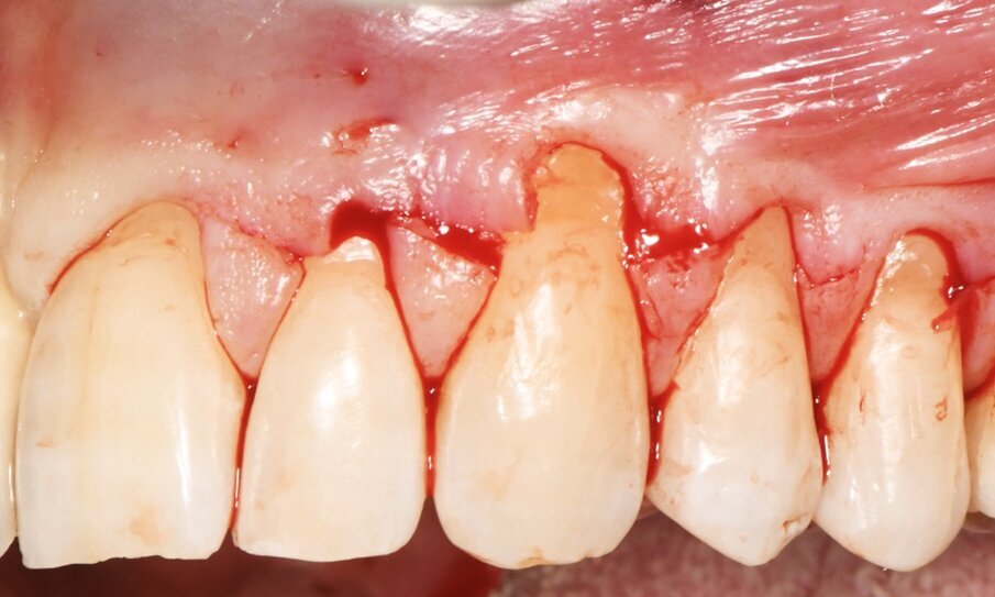 Fig. 3 - Dettaglio delle incisioni primarie, realizzate per definire i limiti coronali del lembo e stabilire il canino come centro di rotazione.
