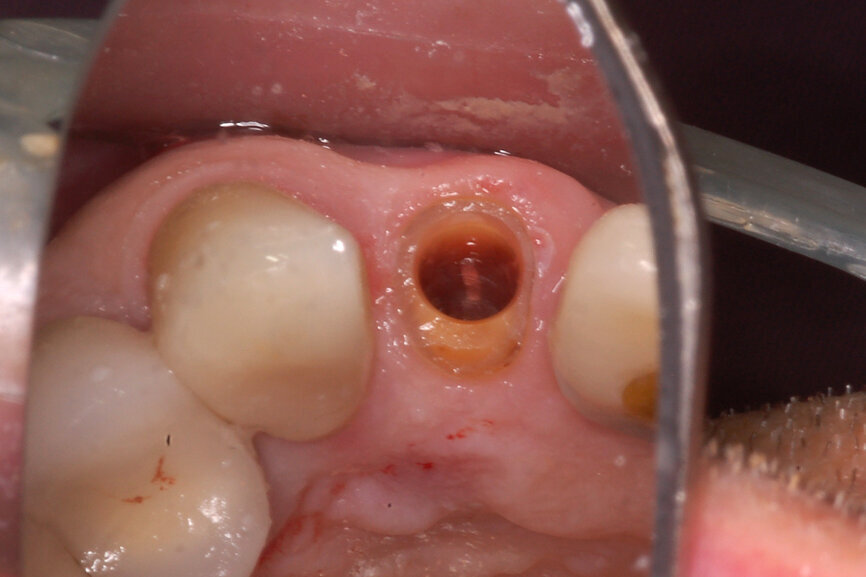 Fig. 9: The cylindrical tooth preparation resulted in the desired crescent shape of the root fragment to provide adequate space for the implant.