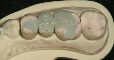 Digital impressions are reality with Cadent