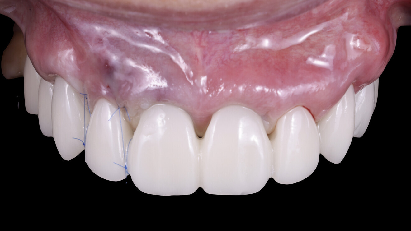 Fig. 22: After delivery of the temporary restoration the day after implant placement.