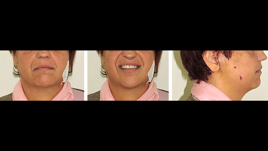 Fig. 7_Immagini extra-orali 7 giorni dopo l’intervento chirurgico.