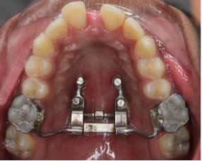 Fig 8b: Post expansion