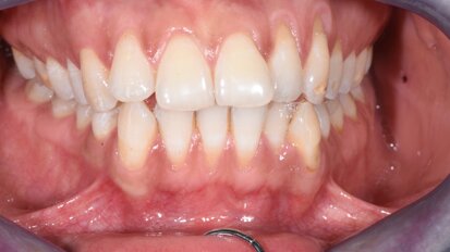 La gestione dell’IPR nei casi ortodontici con allineatori trasparenti