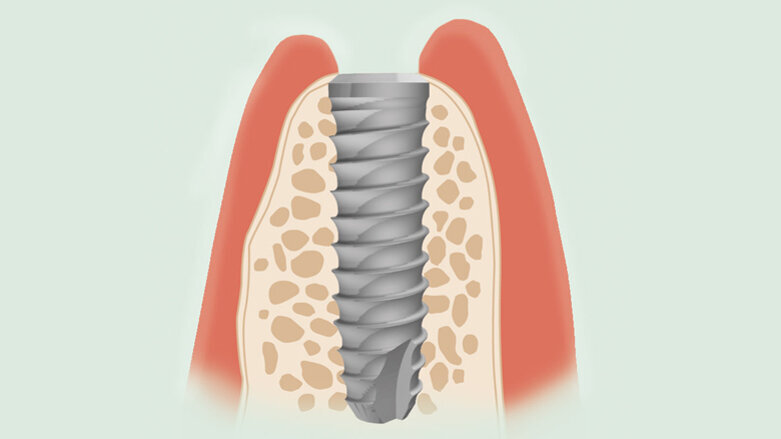 Respetando los principios fundamentales de la implantología