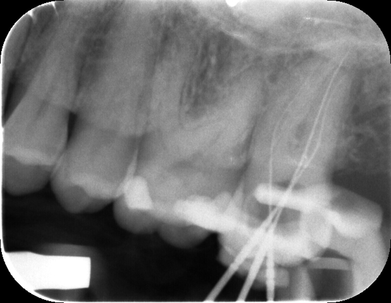 Fig. 2: Measurement radiograph for working length control.