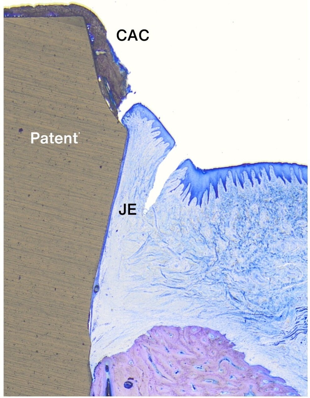 Fig. 2 : Coupe histologique illustrant l’adhésion de l’épithélium jonctionnel (JE) à la surface Patent, formant une barrière biologique efficace qui limite la migration de la plaque bactérienne et du tartre (CAC) vers les tissus. (Photo : Dr Peter Schüpbach) 