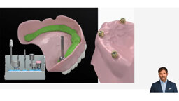 Keystone Dental Group – EasyPro Denture Conversion System