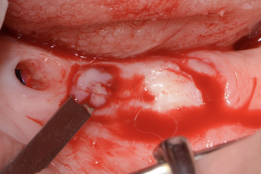 Fig.5 : Incision des bords du lambeau et désépithélialisation.