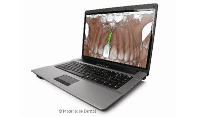 SimPlant® 15 - Maggiore predicibilità della procedura chirurgica e della ricostruzione protesica