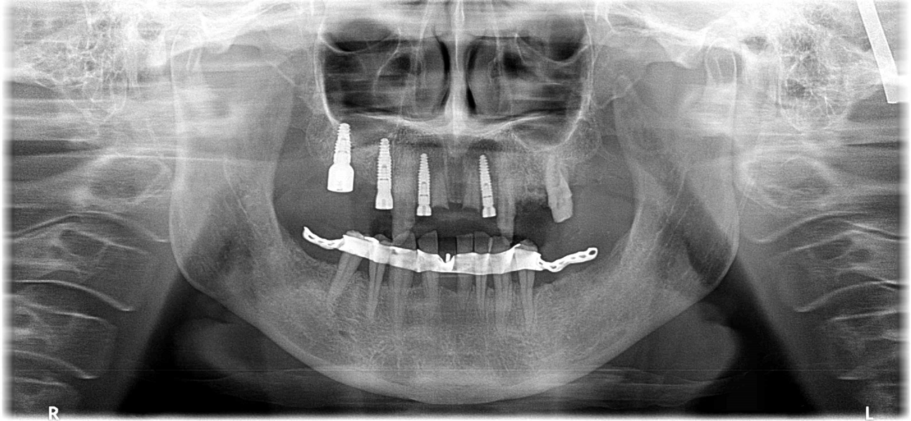Fig. 9: Radiograph after first-stage surgery.