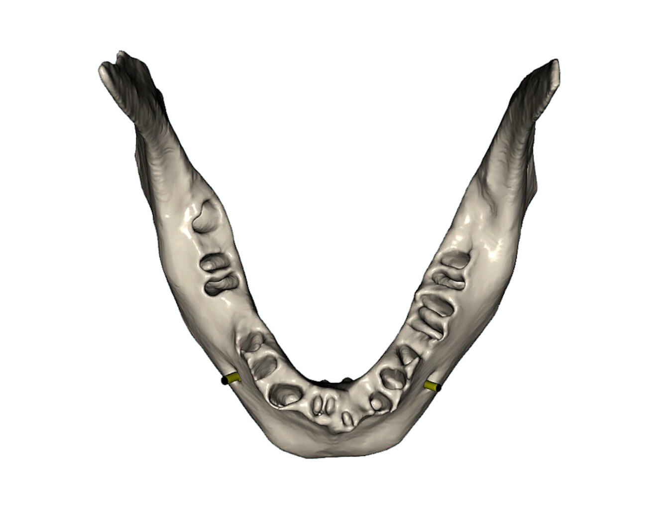 Fig. 14a: Occlusal view of the simulated extraction sockets in the mandibular bone.