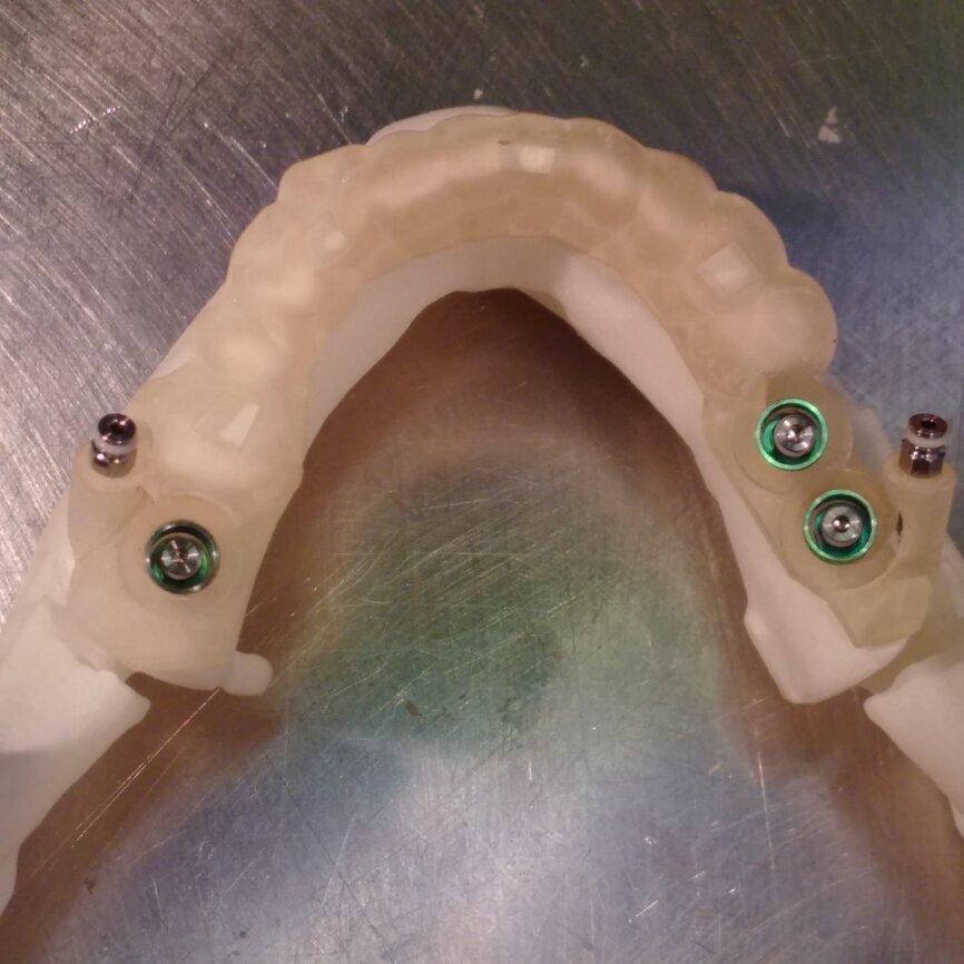 Ryc. 3_Model z szablonem i widocznymi wszczepami po implantacji, szablon ustabilizowany 2 pinami.