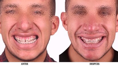 El láser en Ortodoncia (12)