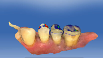 Mill, polish, seat! Indirect procedures in the dental workflow
