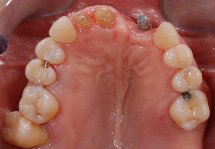 Fig. 4 - Visione occlusale dopo rimozione del manufatto protesico si noti la posizione errata dell’impianto.