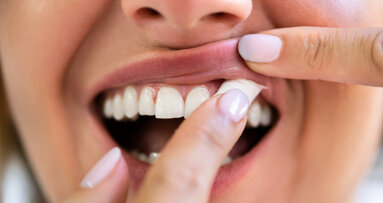 Snus linked to gingival damage but not periodontitis, review finds