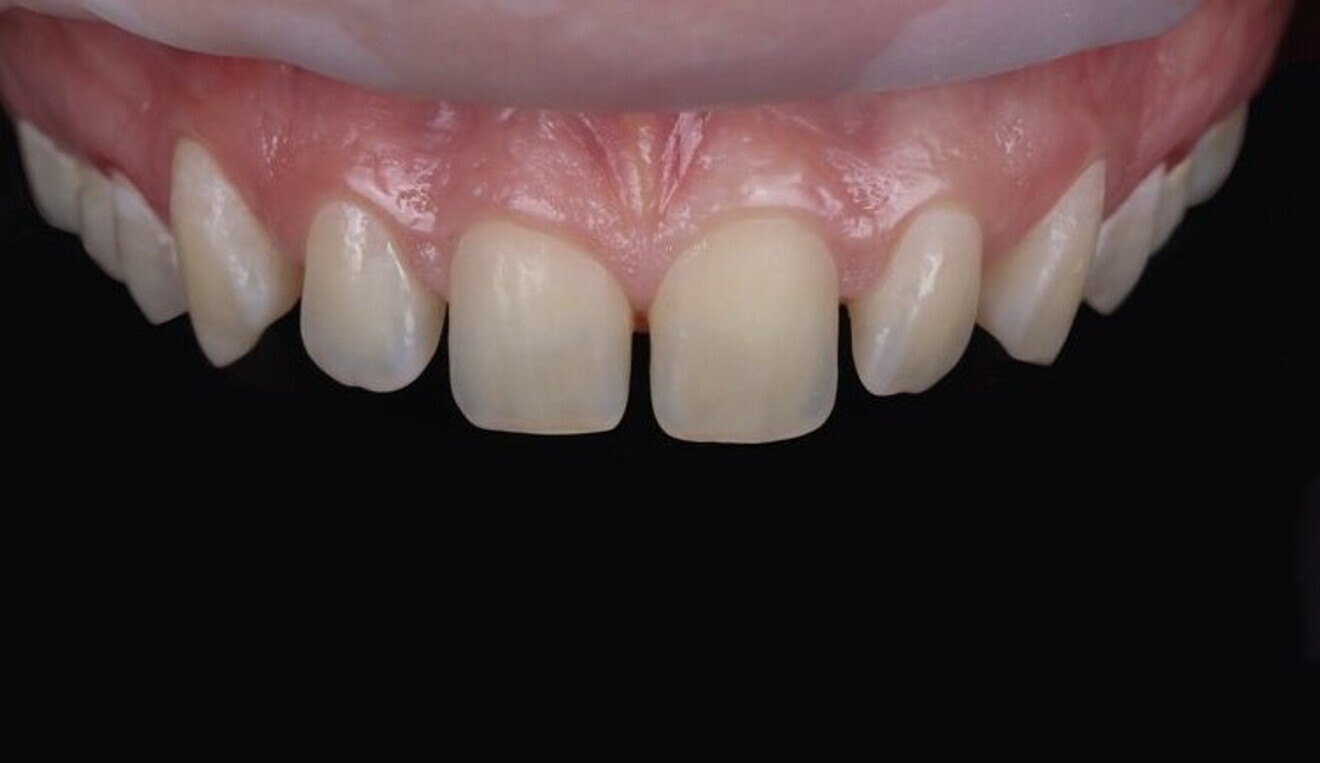 Fig. 2c: Intra-oral view of anterior teeth with the  multiple diastemas.