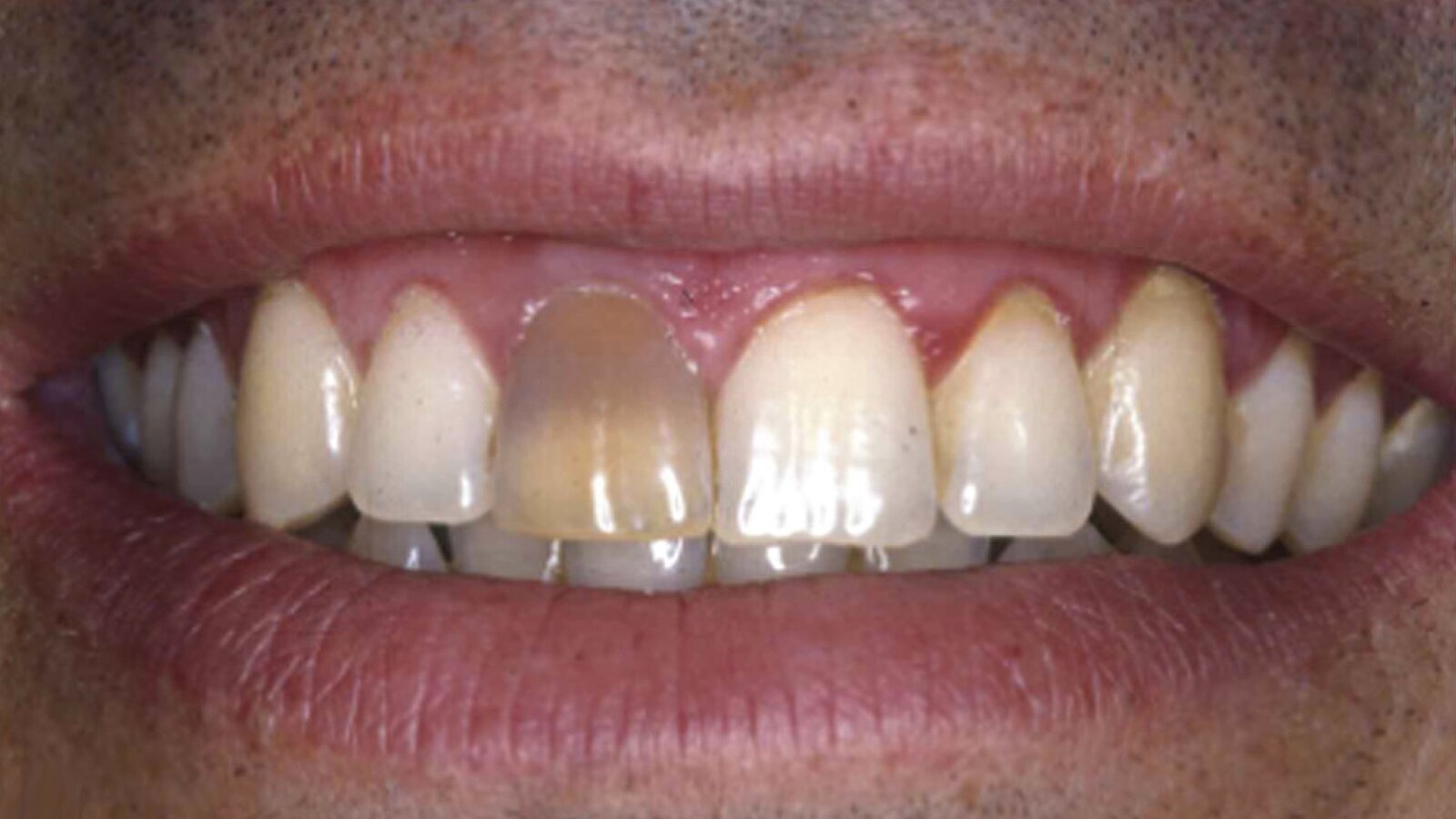 Estética y blanqueamiento dental en la era digital  (Capítulo 7)