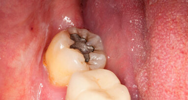 Certain genetic variants may convey susceptibility to mercury poisoning