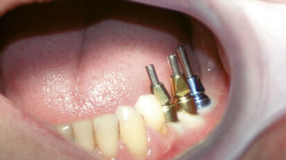 Impianti + Impronte ≠ Complicanze