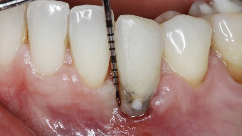 Management kosti a měkkých tkání při komplexní rekonstrukci jednoho zubu implantátem