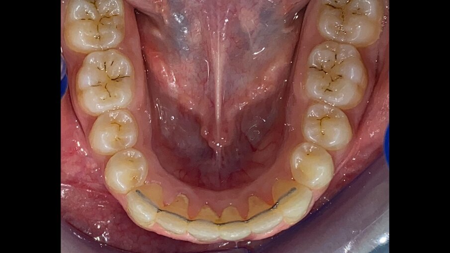 Fig. 22_Occlusale inferiore post-trattamento.