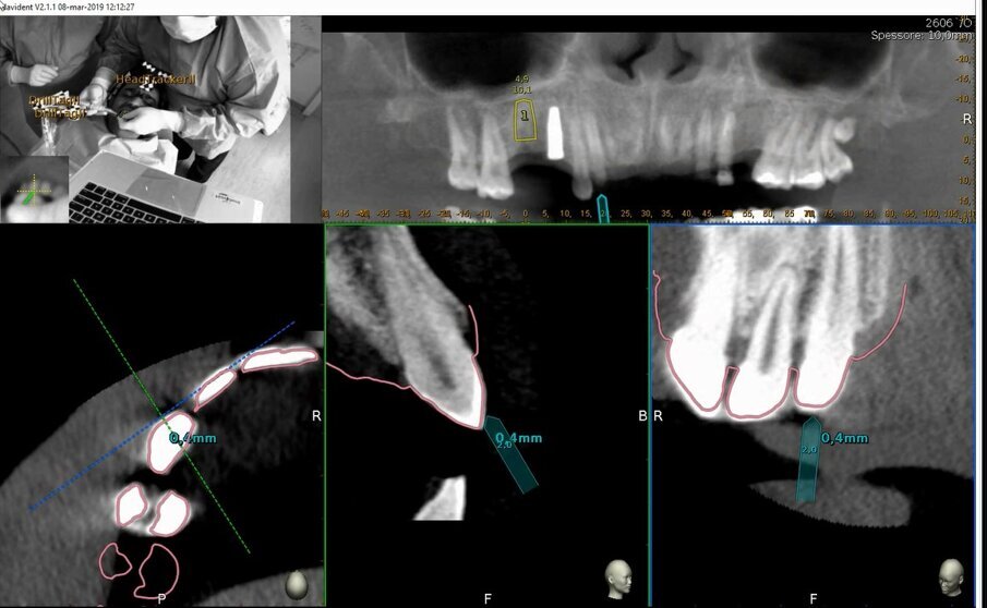 Figg. 13a-13c - Verifica di accuratezza. a) Verifica di accuratezza del Tracer dopo tastatura; b, c) Verifica di accuratezza della fresa prima della fresatura.