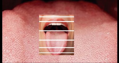 La detección precoz del cáncer oral en la consulta (5)