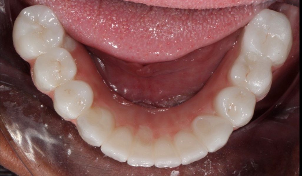 Fig. 37: Mandibular occlusal view of the completed case.